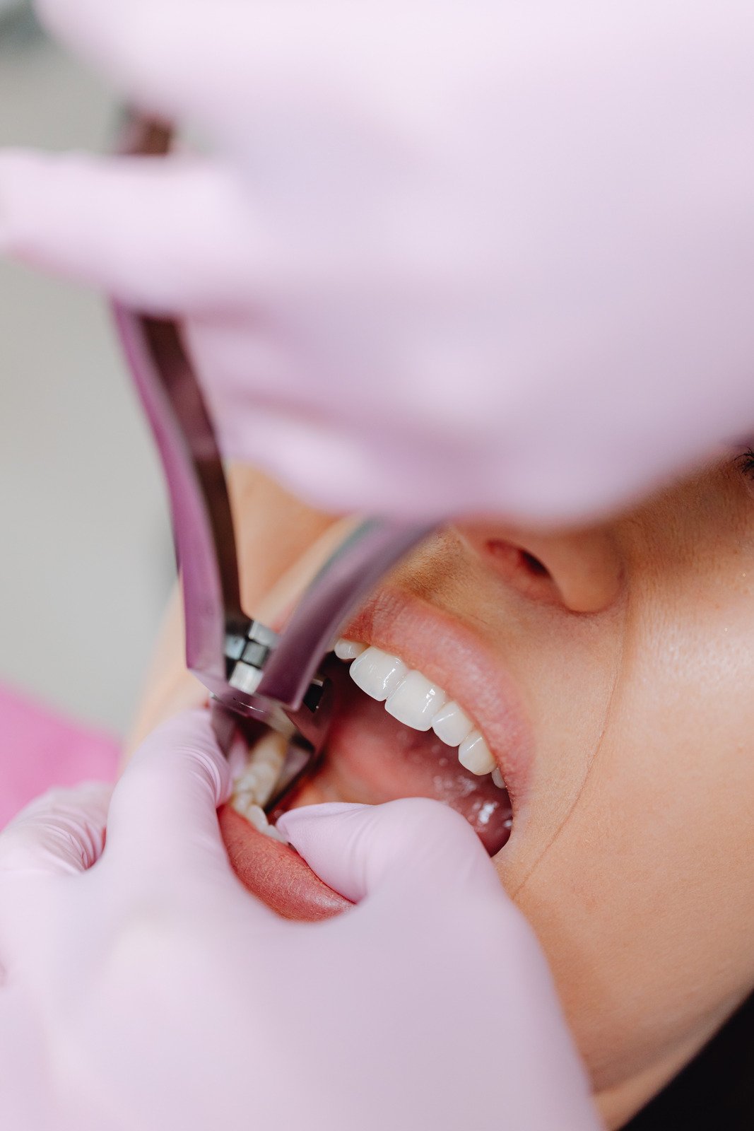Kennesaw Tooth Extractions