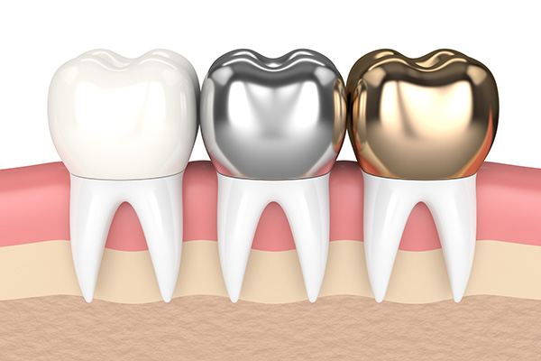 Exploring Dental Crown Types