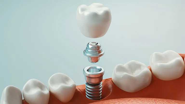 Dental Implants Dentist Near Kennesaw Ga